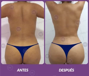 Lipotransferencia 12